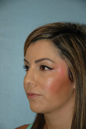 Rhinoplasty