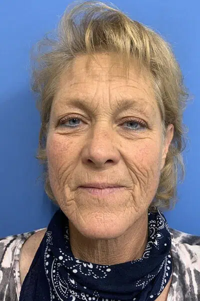 Before Facelift Surgery Before image of female patient pre facelift surgery